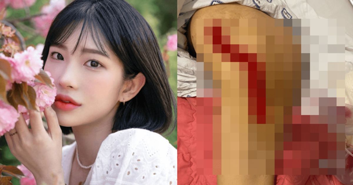 "하반신 잘라내"...최진실 딸 최준희, 극심한 골반 괴사 고통 겪고 있는 충격 근황